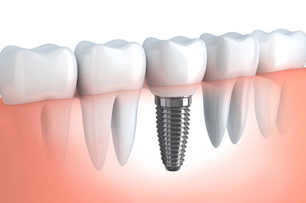 Dental Implant