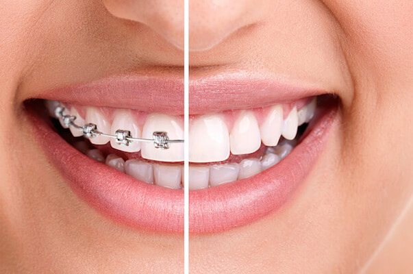 Orthodontic Treatment