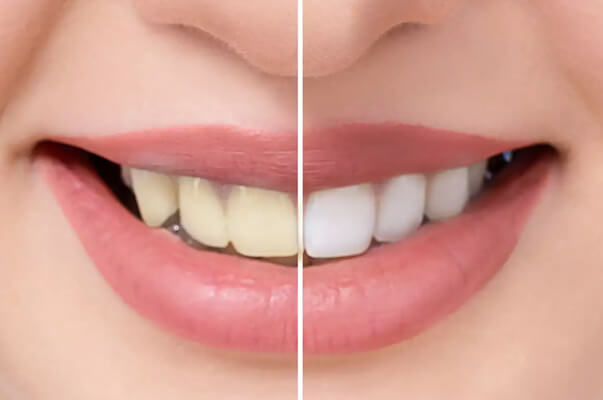 Teeth bleaching
