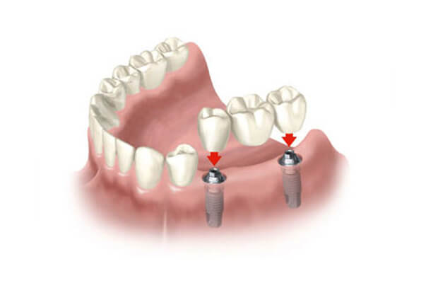 Dental Bridge